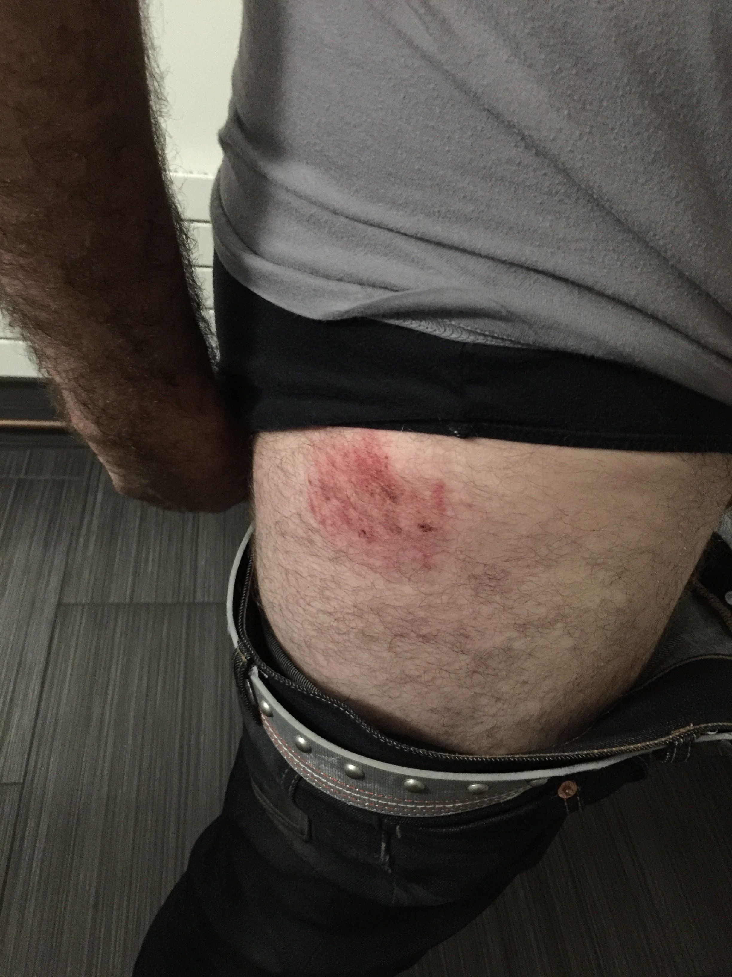 This is the road rash I got with the slightest crash, not bad, but I need Kevlar